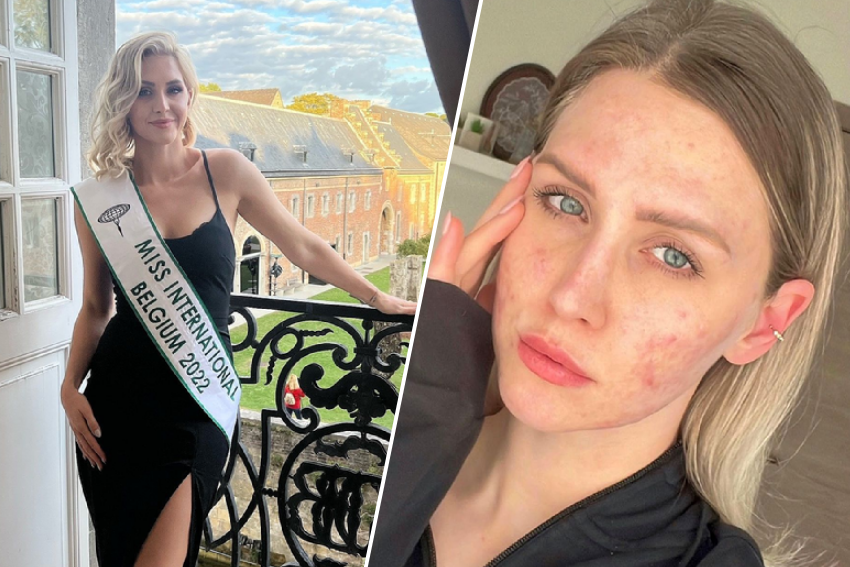 Lore wins beauty pageant despite severe acne: "So you don't have to be perfect" (yellow)